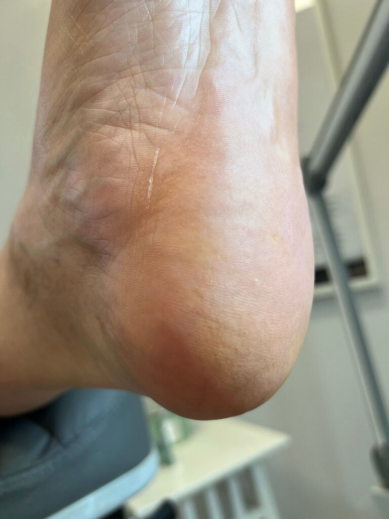 terapia pAkajAcych piAt po